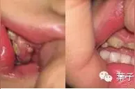 牙龈上长脓包了，吃药能好吗？#葉子口腔科普#图片