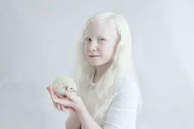白化病人也很美图片