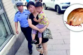 蜱虫钻进三岁娃头皮里 民警帮忙紧急送医图片