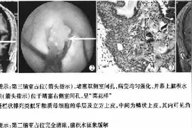 病例：镶嵌技术治疗新生儿左心发育不良综合征1例图片