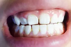 牙齿上有白斑？不仅影响美观，而且可能出现口臭，教你除掉它们
