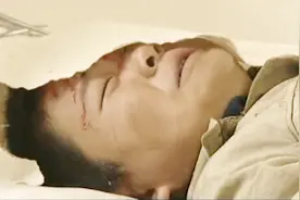 小孩头被撞破了，去医院缝针，不打麻药居然一声都没叫视频封面
