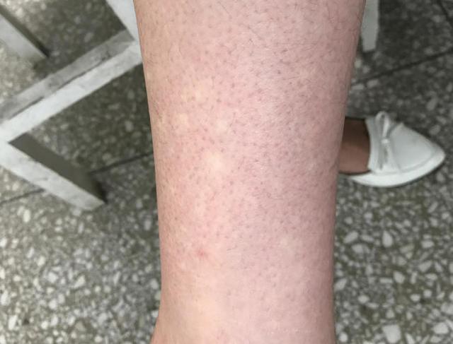 小腿莫名出现很多"白斑",以为是白癜风,原来是虚惊一场