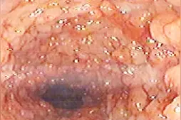 结肠炎虽不严重但治疗不当会反复复发 医生说日常生活中必须注意这一点才会好的快视频封面