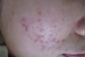 痘印专题，现在教你如何应对顽固的痘印，做一个完美的小清新图片