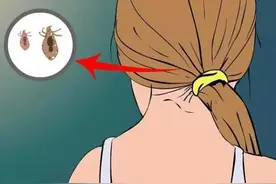 她天天洗头竟还是长了满头的头虱！竟是因为这个“小错误”图片