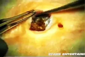 最大的5个黑头被挤出，我感觉莫名的舒服，我是不是病了？图片