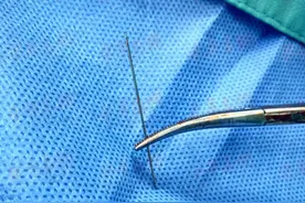 催乳师大意“遗落”缝衣针 医生乳腺管内巧取钢针图片