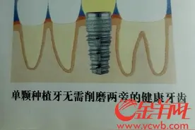种植牙虽好，肿瘤高血压糖尿病人都要择期慎种！图片