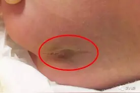 专家在线丨宝宝尾骨处有个坑是怎么回事？放任不管可能会引起大小便失禁！图片