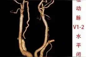 一例椎动脉起始部重度狭窄支架置入治疗图片