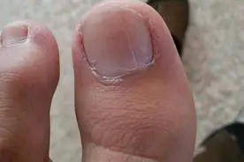 脚趾甲盖发白怎么回事 有何治疗方法图片