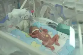 孕期不足6月，双胞胎中的老大就出生了，老二却还在妈妈肚里生长图片