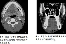 病例：颌下区肿块，是何原因图片