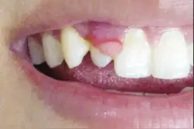 刷牙别太狠 小心牙龈瘤图片