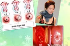 「微提醒」就医被诊断为宫颈癌！每年都体检为啥还会患此病？只因体检时……图片