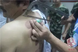 男子在家拔罐罐子却死活拔不下来，消防员用锯子才割开！图片