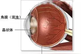 「科普」角膜移植后能让人重见光明！医生带你认识三种角膜移植手术图片