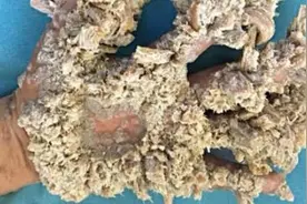 巴勒斯坦男子患罕见“树人症” 皮肤肿起如树皮图片