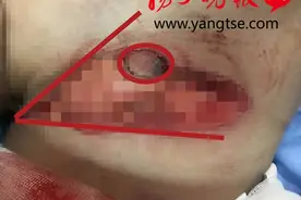骑自行车摔倒，车把手从12岁男孩大腿丫斜插进腹腔图片