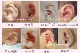 耳朵长的“很有特色” 可能属于耳廓畸形需早治图片