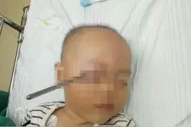 惊险！不锈钢筷子从一岁多幼儿眼睛插入颅内图片