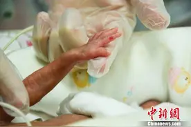 重庆袖珍双胞胎出生40天历险记：姐姐出生时仅490克图片