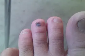 发现脚趾甲变黑是不是得了黑色素瘤？视频封面