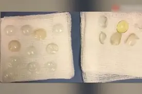 可怕！女子做手术竟从眼睛中取出27个隐形眼镜，用生命告诉你隐形眼镜到底能不能戴视频封面