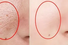 脸上有螨虫不要慌，每晚抹点它轻松祛螨，第2个堪称螨虫克星视频封面