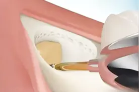 3D动画演示拔除智齿的过程，看的我都牙疼了！