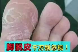 脚底脱皮千万别忽视，只需3招告别烦恼！视频封面