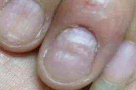 5种指甲形状对应5种疾病，很多病都可以预防，你还不知道？视频封面