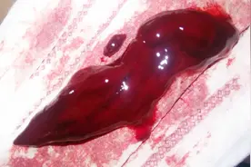 药物流产，简单，有效，又无创伤 但药后需要注意什么你知道吗？