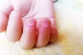 眼白长斑点就是有虫？医生爸爸控诉最坑爹的4个长虫特征！图片