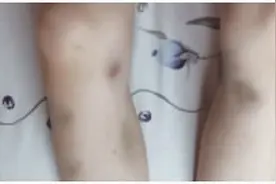 孩子身上不停的出现淤青红斑，到医院的检查结果让人吃惊图片