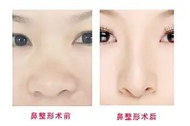 赵广文谈鼻头肥大矫正术图片