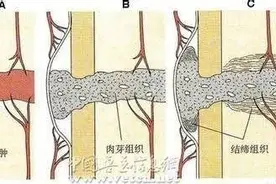 骨折愈合过程及愈合时间表图片