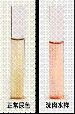 从尿液看你的健康状况，你中招了吗？