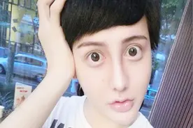 蛇精男刘梓晨晒朋友圈又整容了，全脸打了10几针，这次终于变帅了