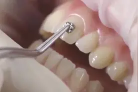 自锁托槽矫正，真人实录戴牙套全过程，每一步都是关键！