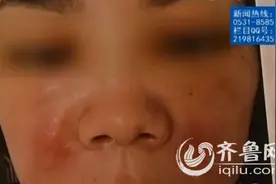 济宁女子微整形后毁容 记者调查：玻尿酸假货多图片