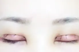 这几种人最好不要做双眼皮手术，否则会引起严重后果