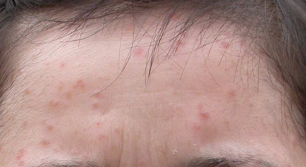 扁平疣属于汗管角化