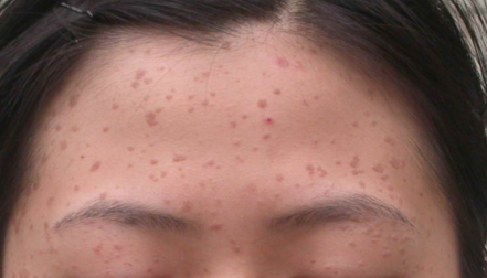 扁平疣属于汗管角化