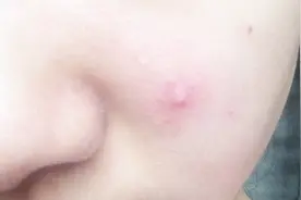 痘痘里面挤出来的白色东西是什么？