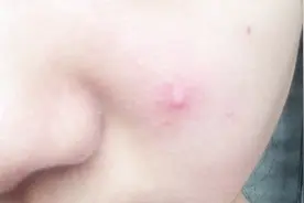 痘痘里面挤出来的白色东西是什么？