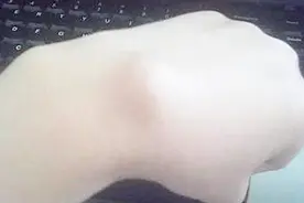 手上长了个硬包块，有可能是肿瘤吗？权威专家告诉你答案视频封面