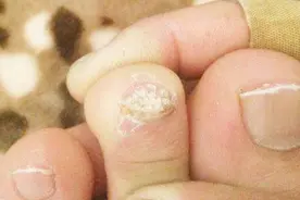 脚趾甲变厚、变黄，小心灰指甲找上你，你有没有？视频封面