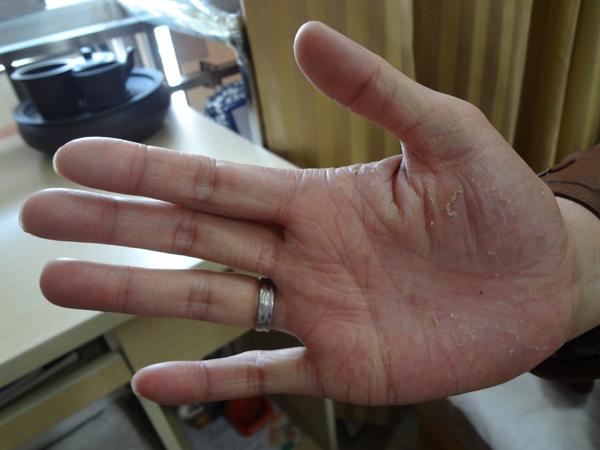 中医名家验方治疗鸡皮疙瘩